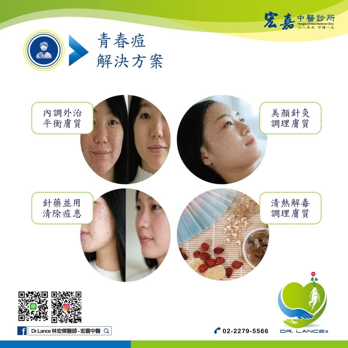 新莊青春痘治療，中醫內服、針灸、美顏針改善痘痘